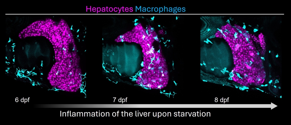 LiverSteatosis