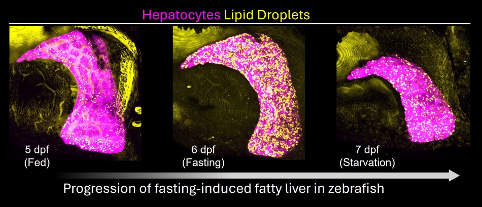 LiverSteatosis